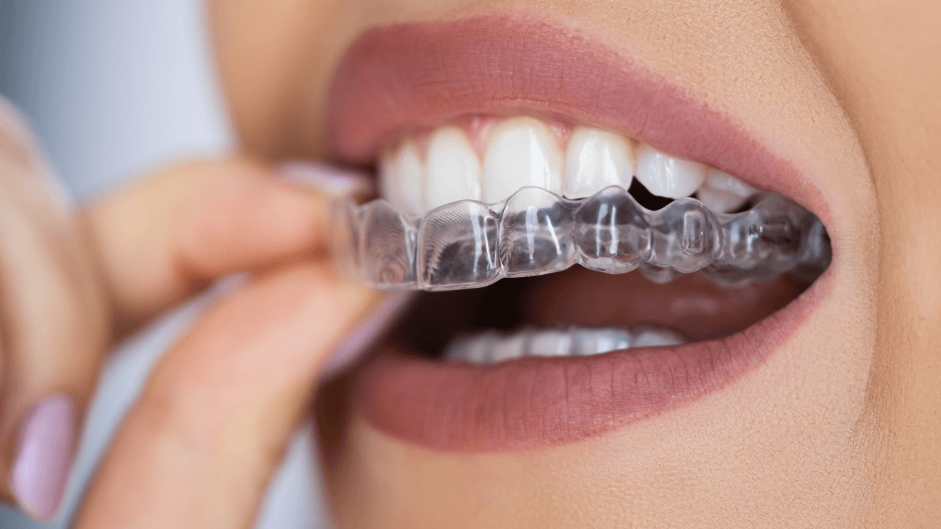 Orthodontic Treatment